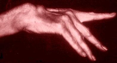 Arthritis-Hand