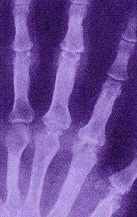 Arthritis-Röntgen